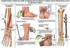 ankle fractures  subsequent surgical fixation  placement