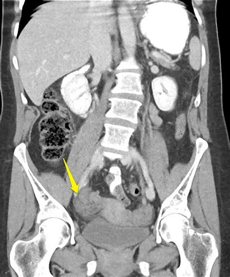 Ovarian torsion causes, symptoms, diagnosis & ovarian torsion treatment