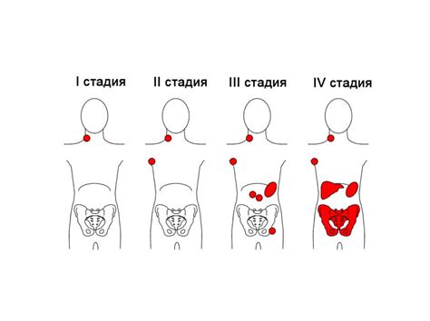 Ходжкина лимфома