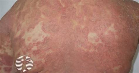 Generalised pustular psoriasis image