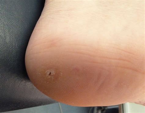 Verruca Pedis Treatment - Laser Wart Treatment | Wart Specialist