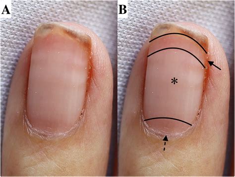 how to cut fingernails 5