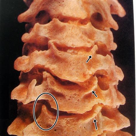 O Que É Uncoartrose - Uncoartrose Bilateral Em C5-c6 E C6-c7 - RETOEDU