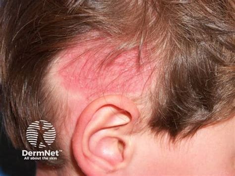 tinea capitis
