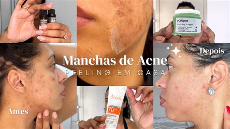 Tira Mancha De Acne Do Rosto - Como tirar manchas de acne do rosto com PEELING QUÍMICO + Atualizações ...