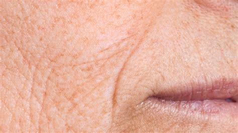 Wrinkle Removal Treatment Southend-on-Sea, Essex