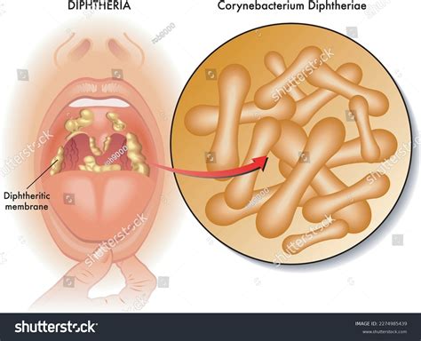 corynebacterium diphtheriae pharyngitis