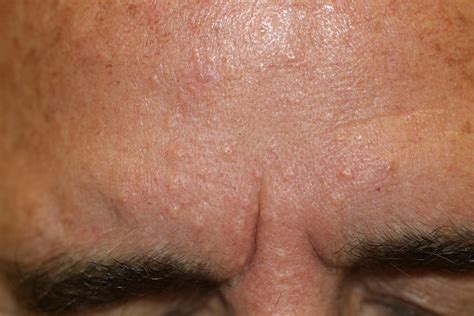 Bumpy Skin, Sebaceous Hyperplasia and Electrocautery by Deborah Tosline