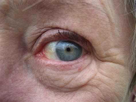 how to get rid of eye wrinkles