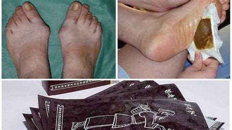 Китайский магнитный пластырь Hyperosteogeny: отзывы на пластырь от ...