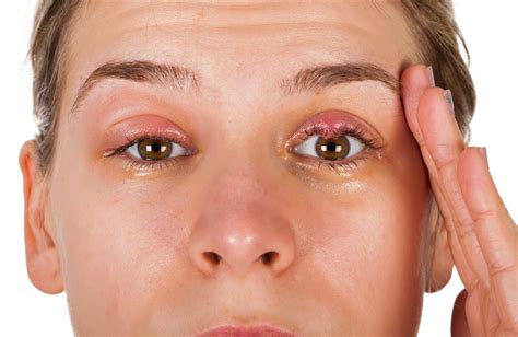 Swollen Eyelid Treatment: Causes, Symptoms, and Remedies | MaxinHealth ...