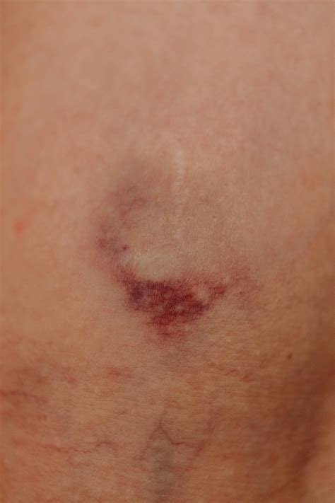 common reasons bruising increases  age trend news