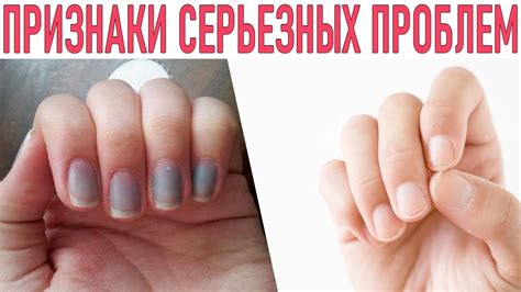 НОГТИ ИНДИКАТАР ЗДОРОВЬЯ | Заболевания которые можно выявить по ногтям ...