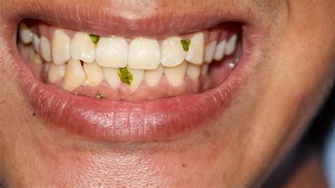 kenali coated tongue penyebab bau mulut klikdokter