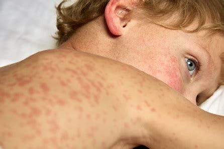 measles robert gallery