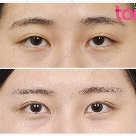 Korean Double Eyelids Surgery: Guide To Different Surgical, 44% OFF