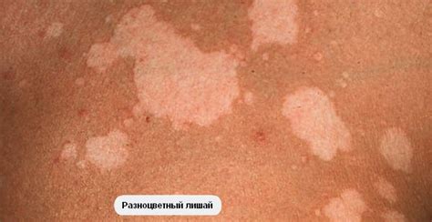 Як вилікувати лишай у дитини? призначаються препарати — Zdorovia