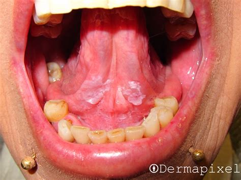 Lesion En La Lengua Blanca Flash Sales | cdlguaiba.com.br
