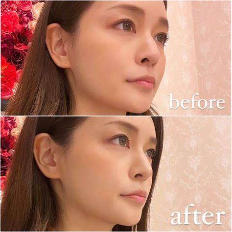 橘メアリーさんのインスタグラム写真 - (橘メアリーInstagram)「🥰💋🥰💋 ・ ・ Aクリニック新宿院@aclinic ...