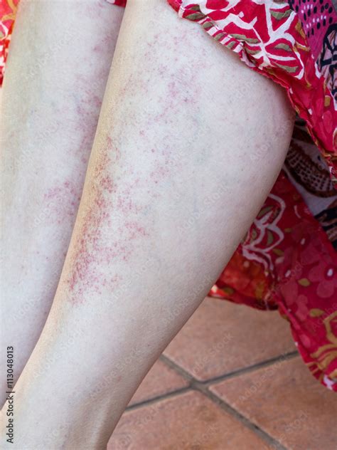 Sun adverse reaction, allergy, red rash on legs. Stock Photo | Adobe Stock