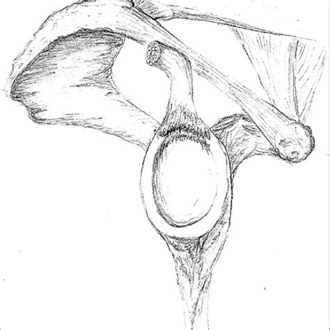 -AP and lateral radiograph revealing the AIIS injury. | Download Scientific Diagram