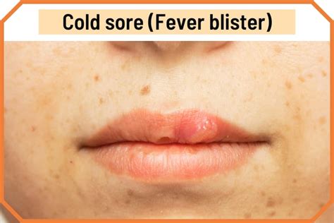 blister  lip cold sores      pictures