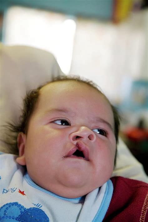 Baby With A Cleft Lip Photograph by Jim West - Pixels