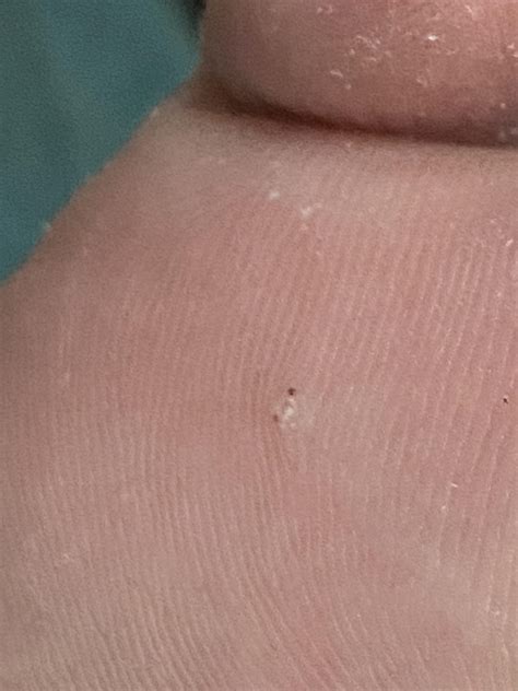 early plantar wart rwarts