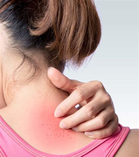 Hiv Symptoms Rash - Infoupdate.org