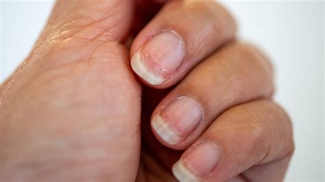 Can Eczema Cause Nail Pitting - Bios Pics