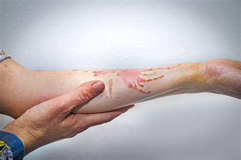 Burn Healing Cover Or Not at Francis Walker blog