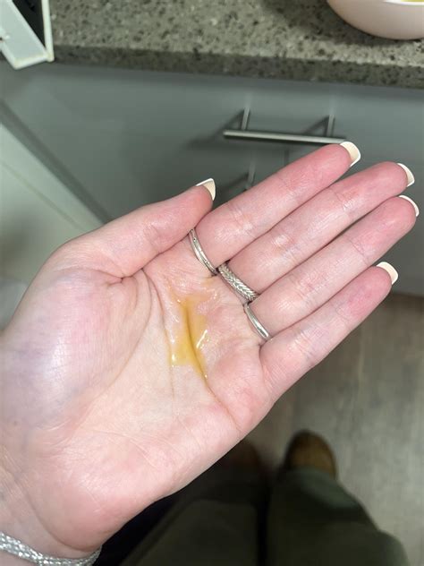 fluid leaking out of nose?? : r/medical