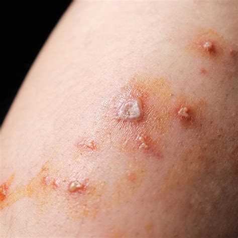 Impetigo Treatment Over the Counter - Day Lewis Pharmacy
