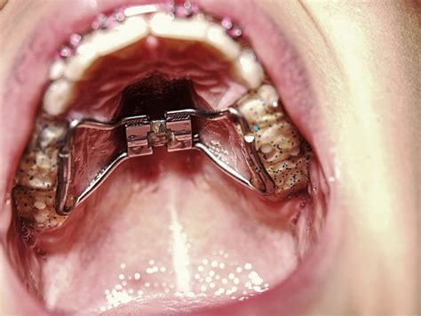 Bottom Palate Expander