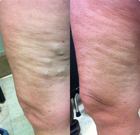 Patient Testimonials Before and After Photos - North Beach Vascular