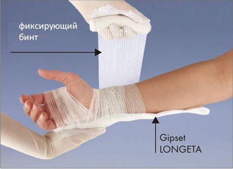Лангет на руку при переломе лучевой кости