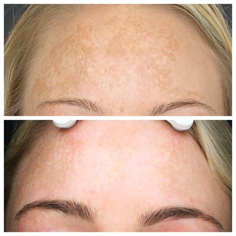 HALO Laser Resurfacing Patient 1 - Blush Aesthetics