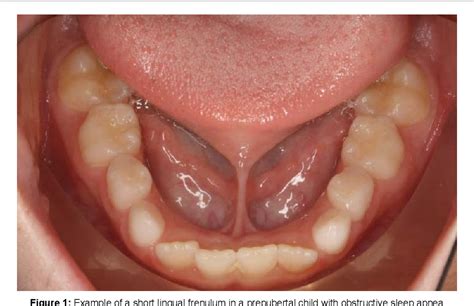 Figure 1 from Lingual Frenulum and Obstructive Sleep Apnea in Children ...