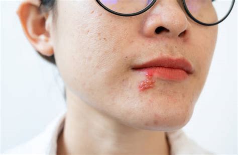Strep Rash Stock Photos, Pictures & Royalty-Free Images - iStock