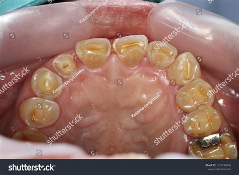 Severe Teeth Attrition Loss Vertical Dimension Stock Photo 1927740068 ...