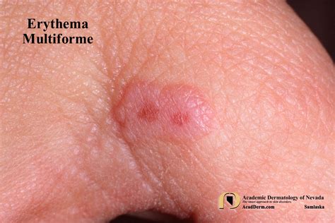 Erythema Multiforme: Erythema Exudativum Multiforme... - Academic