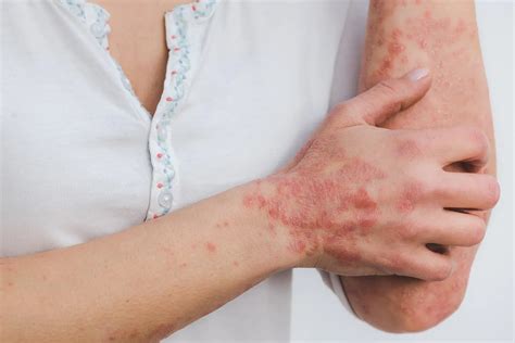 Micose De Pele Tratamento - Micoses de pele: origem, prevenção e tratamento - Infinity Doctors