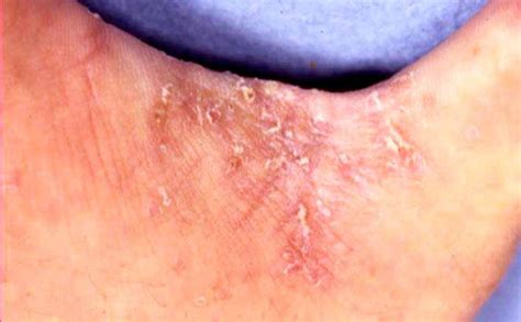 疥癬の症状（通常疥癬） | マルホ 医療関係者向けサイト