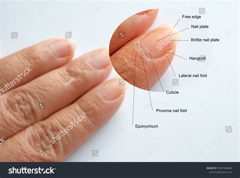 30 Lateral nail fold Images, Stock Photos & Vectors | Shutterstock