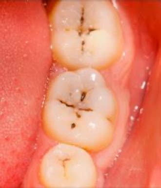 management  occlusal caries flashcards quizlet