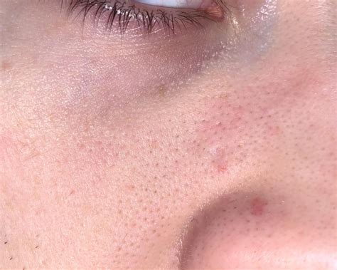 Warning: This Unbelievable Blackhead Removal 2024 Method Is Addictive! Image 16