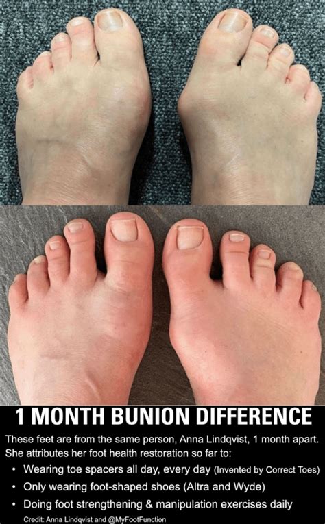 bunions  fixed  surgery  absolutely golden