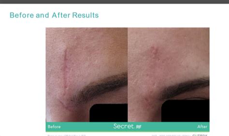 Secret RF Microneedling - beautiful beginnings cosmetic laser center