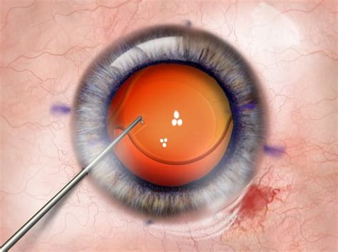 Positioning of toric IOL on ink-marked axis, illustration