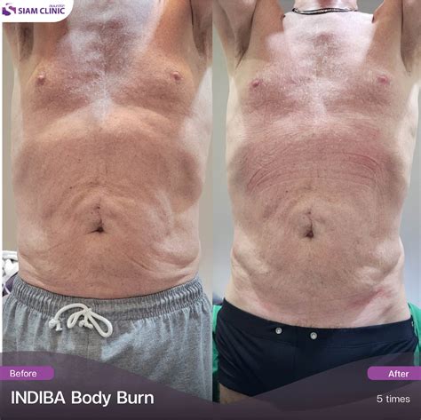 รีวิว INDIBA (INDIBA Reviews) - Siam Clinic Thailand